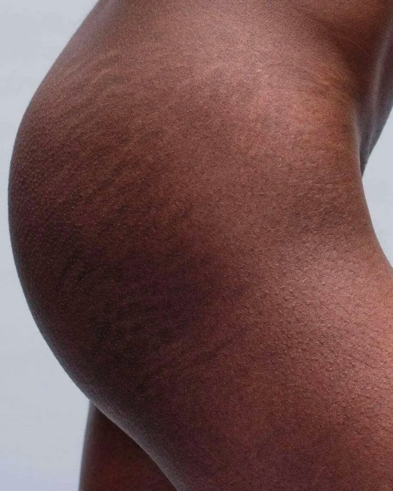remove stretch marks