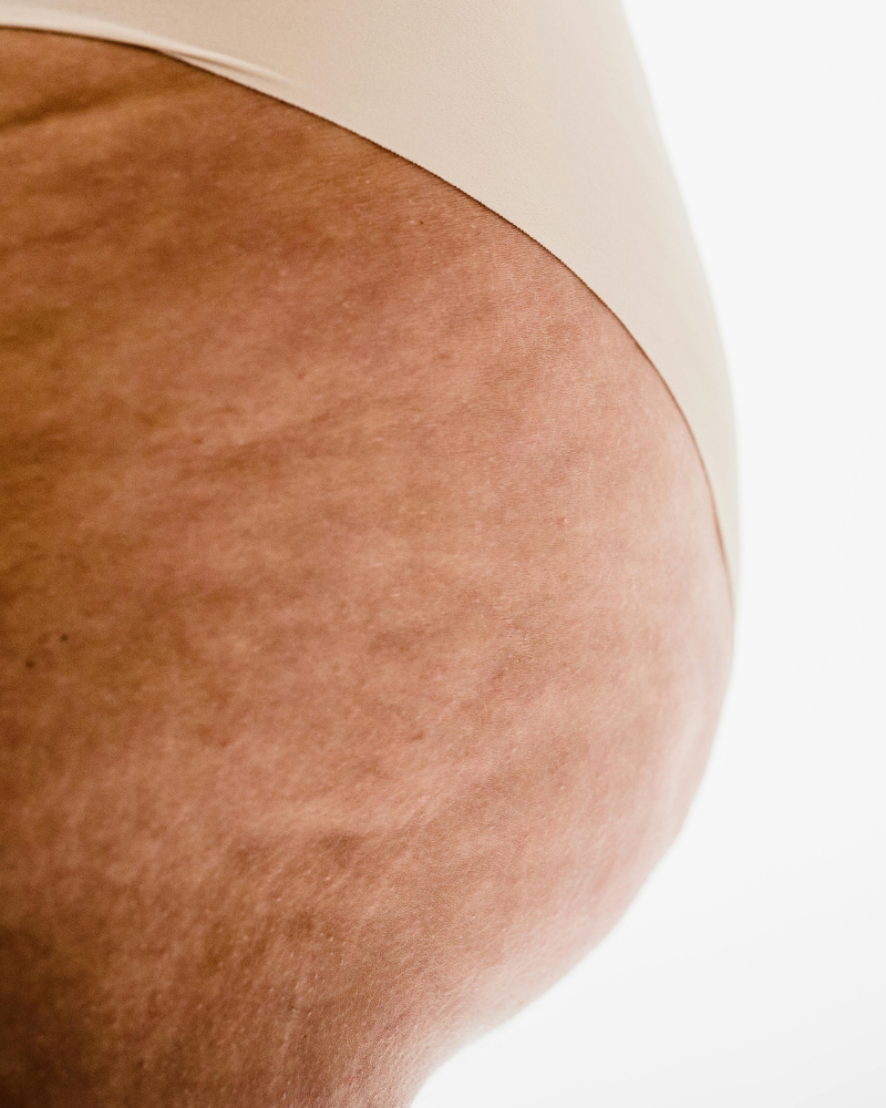 cellulite on skin