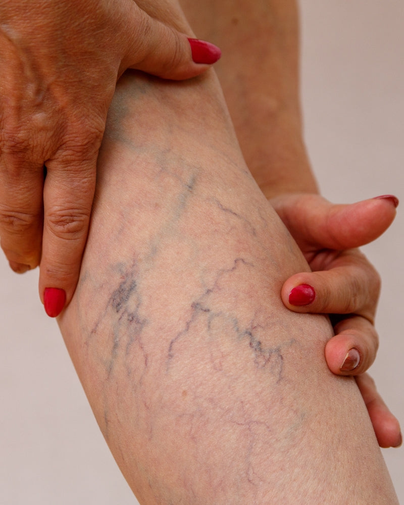 VARICOSE VEINS