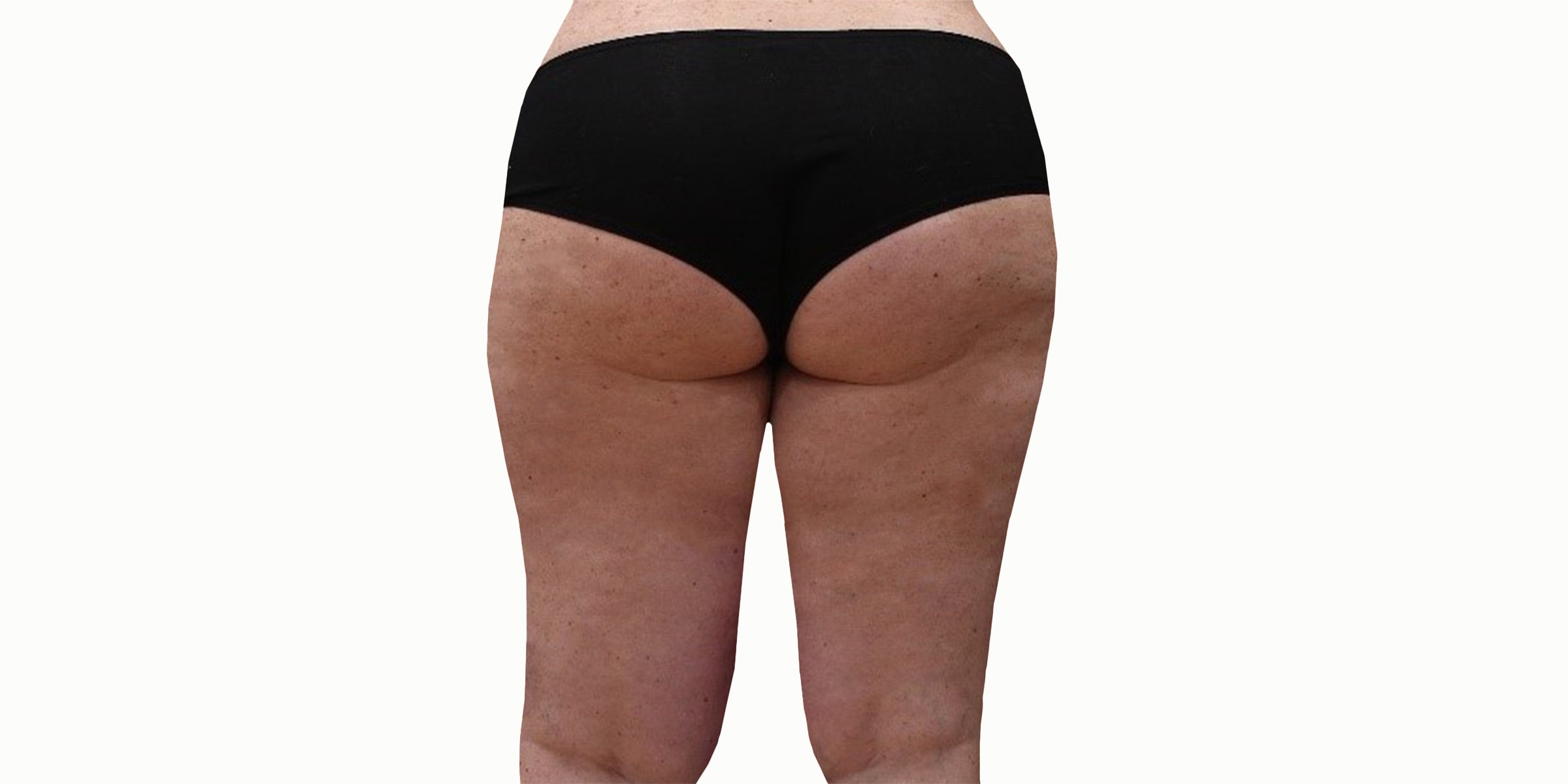 Legology cellulite results