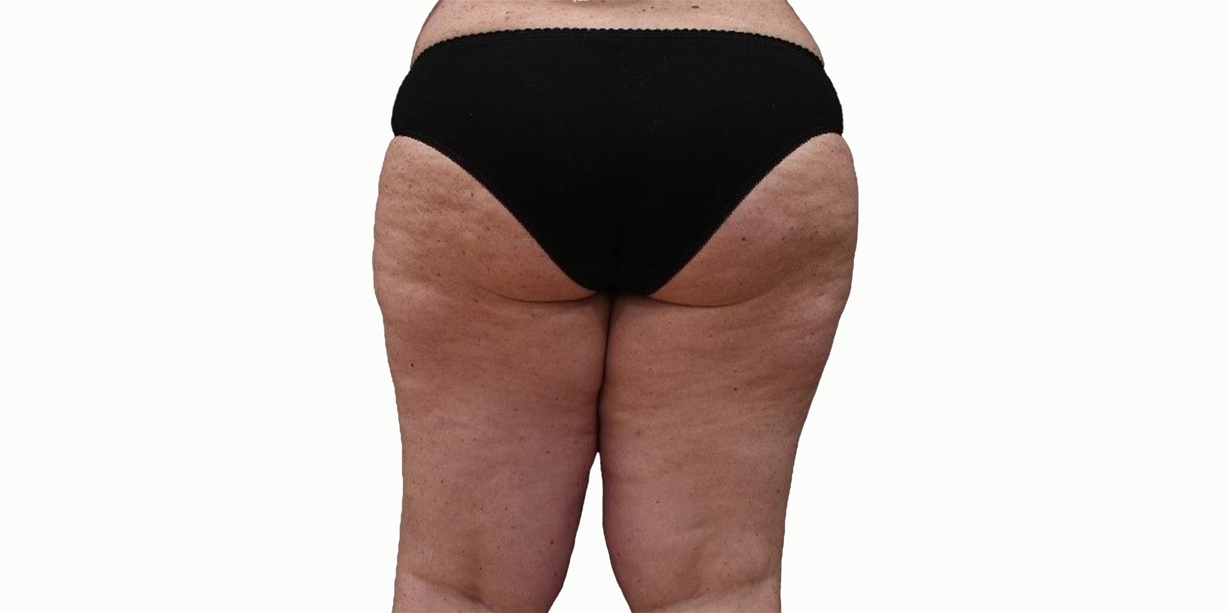 Legology cellulite before and after images