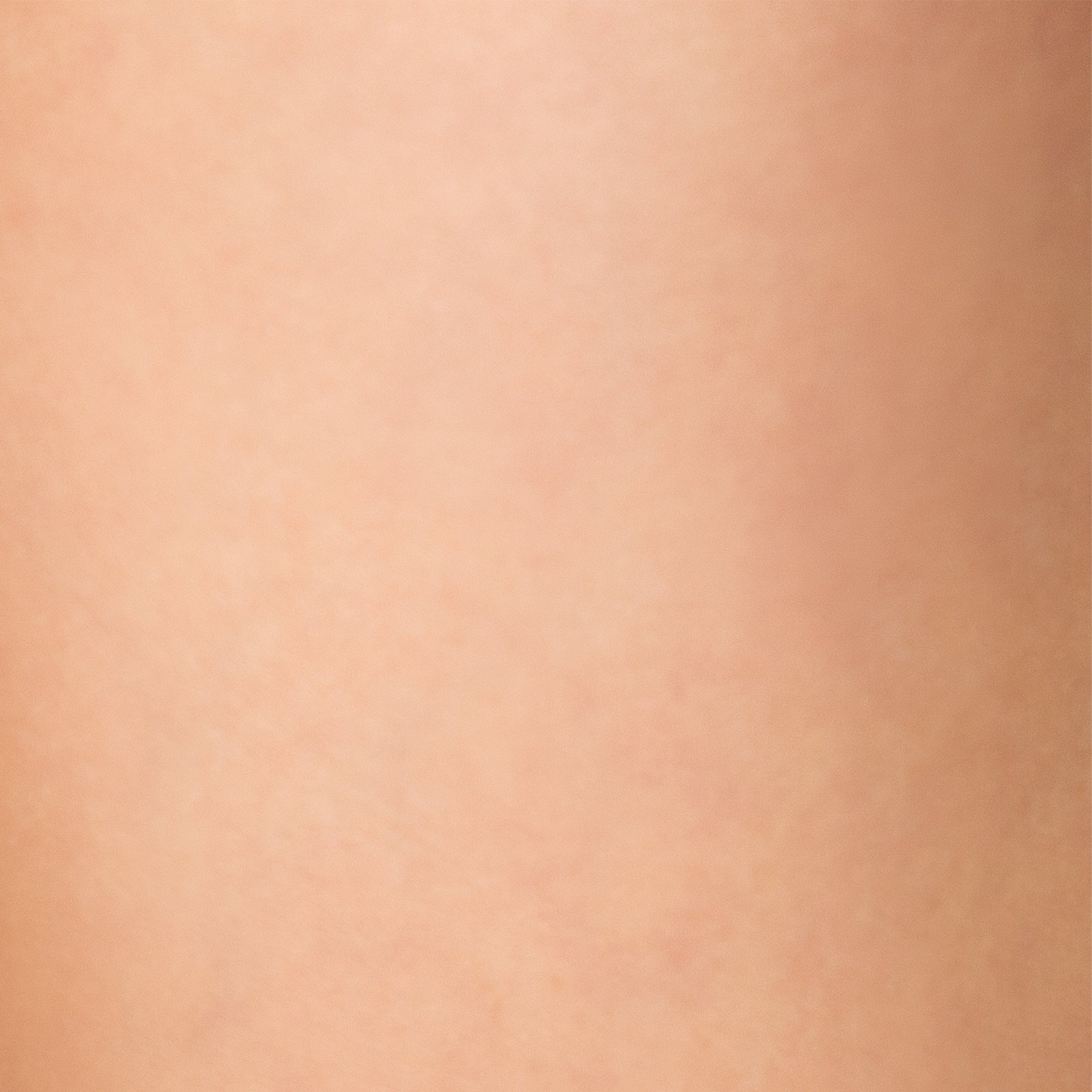 Grade 0 cellulite