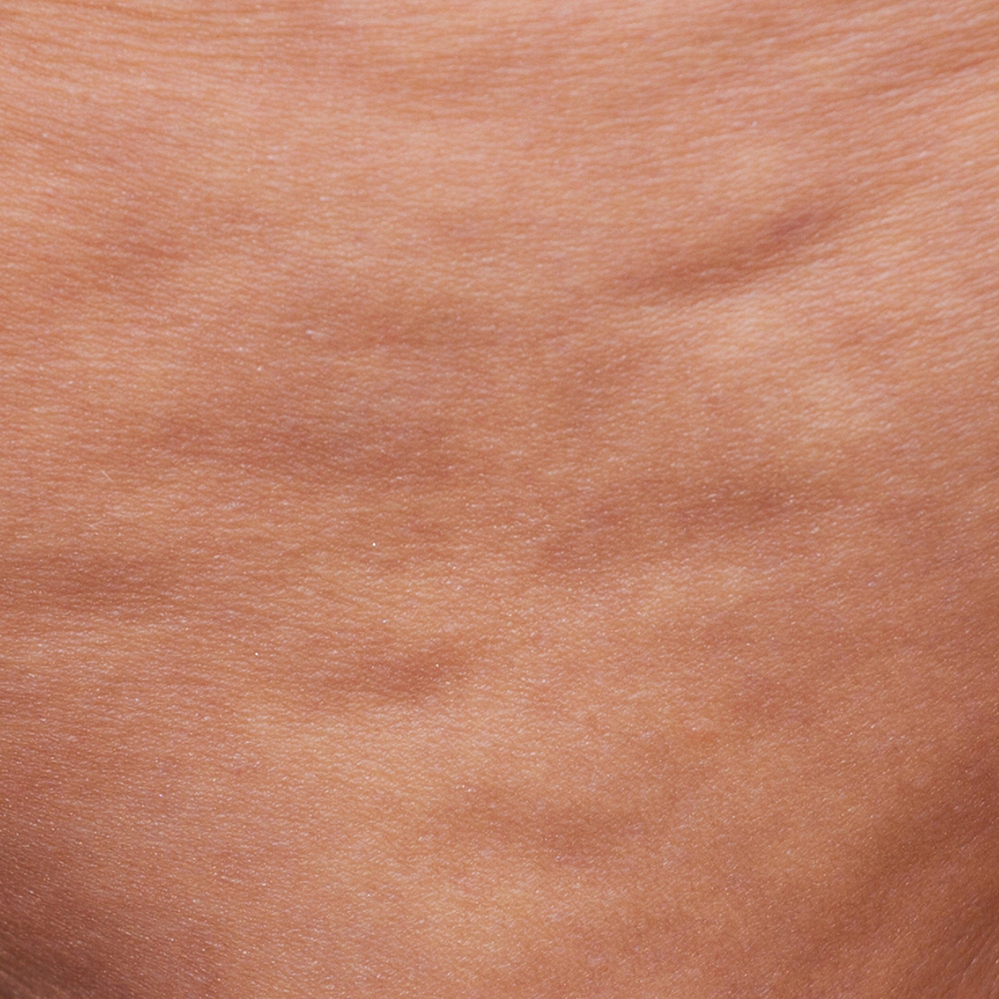 Grade 1 cellulite