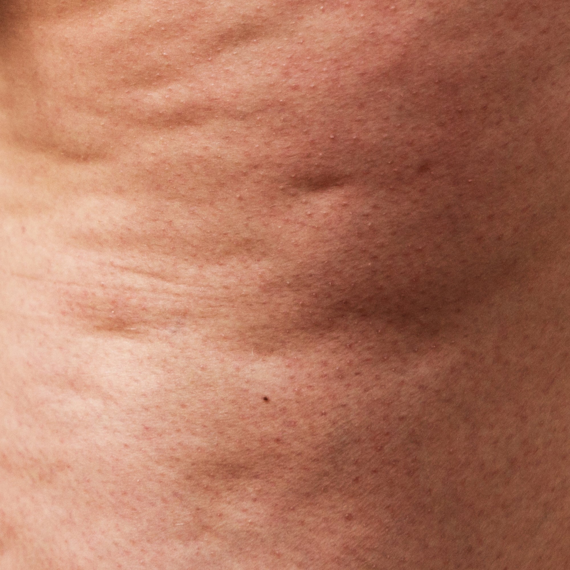 Grade 2 cellulite