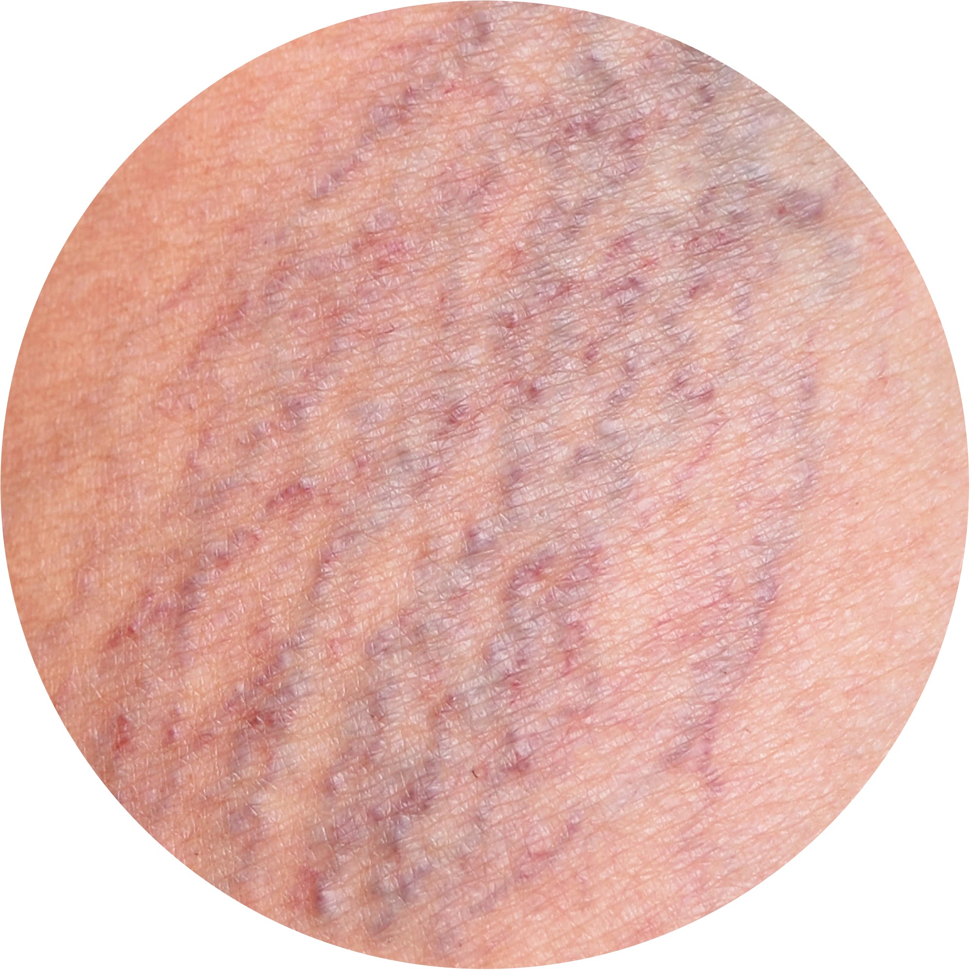 circulation cause of cellulite