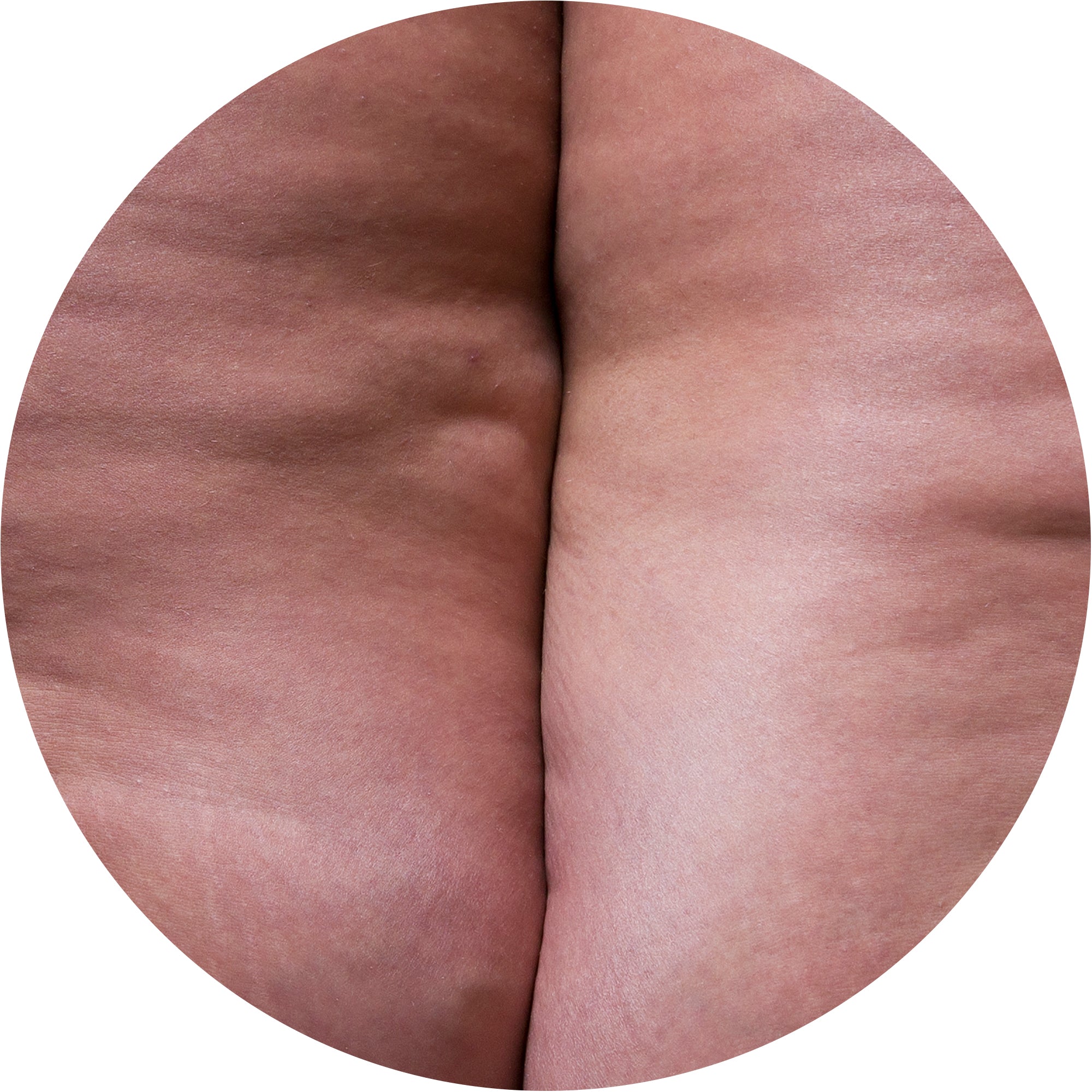 fluid retention
