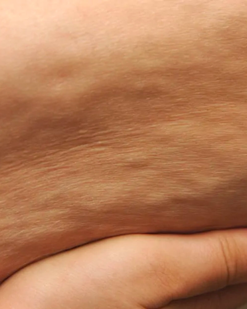 is cellulite normal