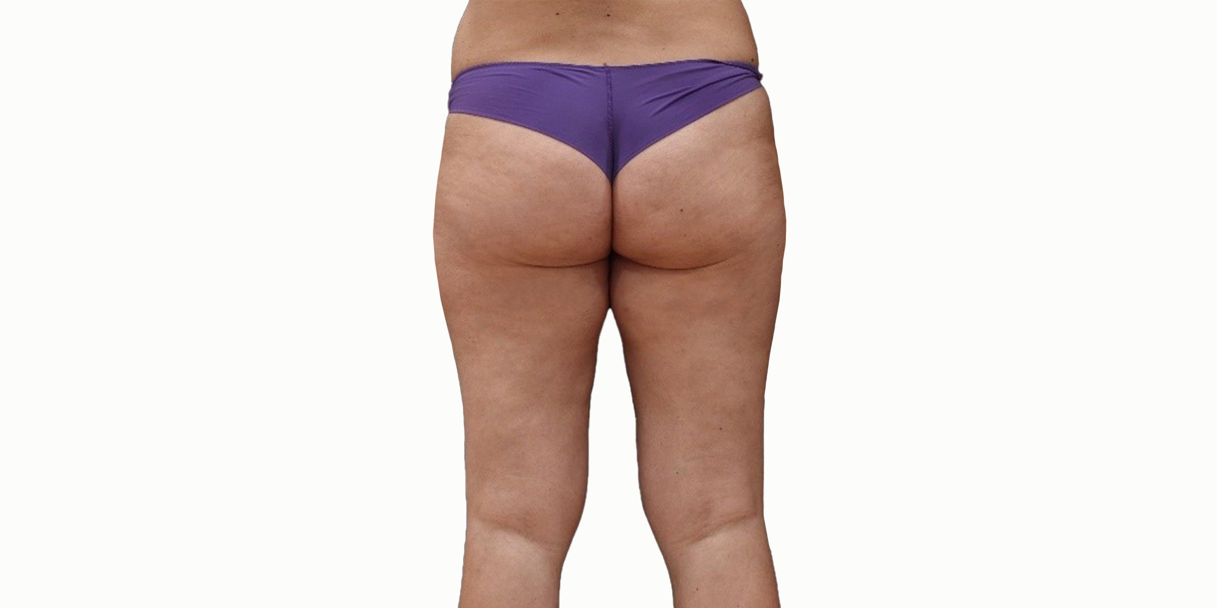Legology cellulite before and after results